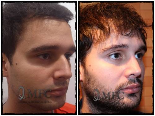 Rinoplastia